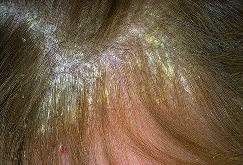 Dry Patches On Scalp
