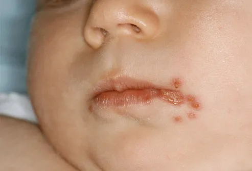 A Mouth Rash in an Infant | LIVESTRONG.COM