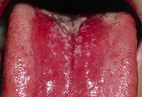 Thrush is an infection of the mouth caused by the candida fungus, 