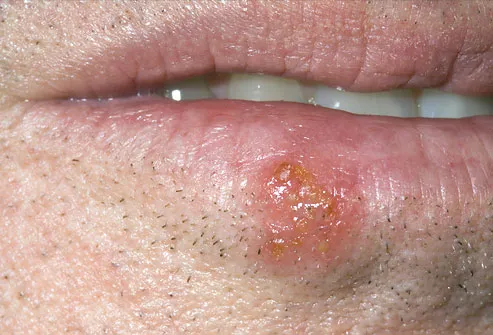 Cold sores (also called fever blisters).