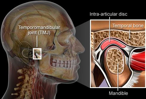 TMJ -- temporomandibular joint syndrome.