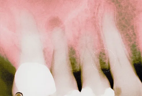 Periodontal disease can lead to receding gums.