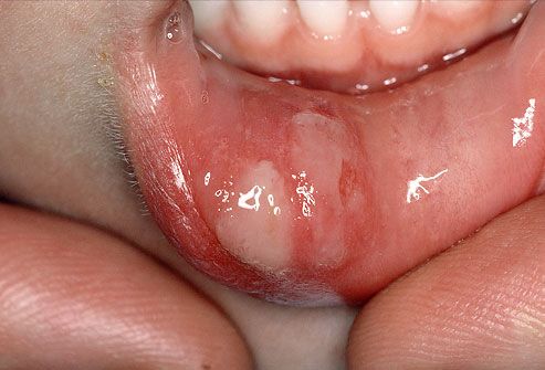 Canker sores (also called aphthous ulcers).