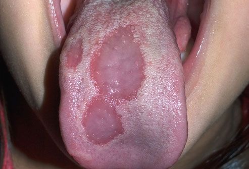 How do you care for painful lumps on the tongue?