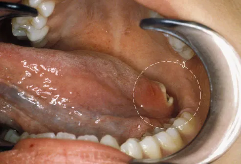 Oral cancer appears as a growth or sore in the mouth that does not go away