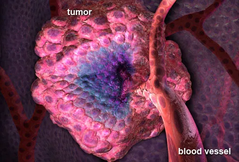 Ovarian Cancer Tumor