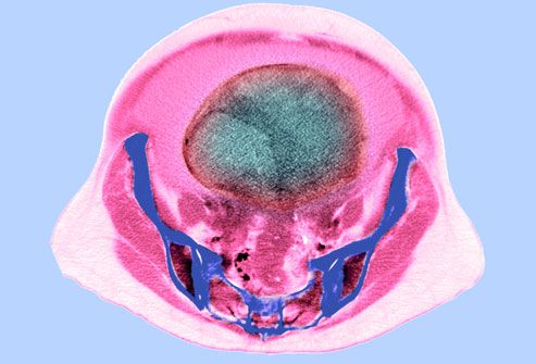 Ovarian CT Scan