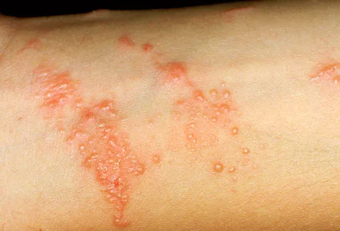 what does poison sumac rash look like. A rash from poison ivy, oak,