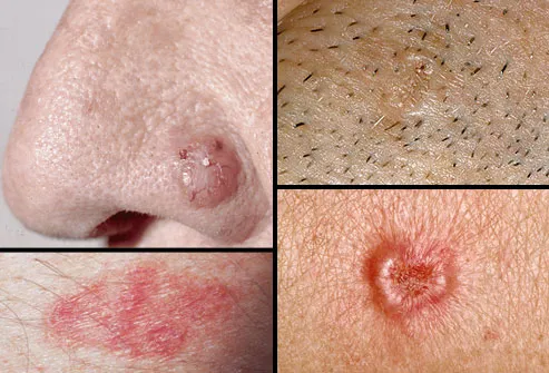 Who determines a spot is skin cancer?