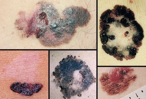 Collage of melanoma
