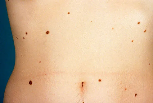 reddish moles on skin