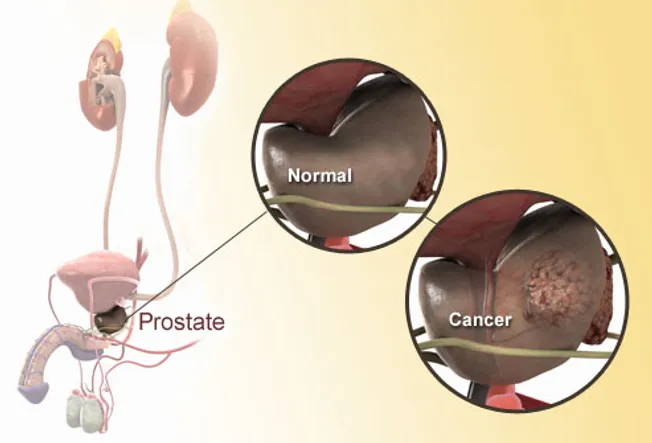 Illustration Of Prostate