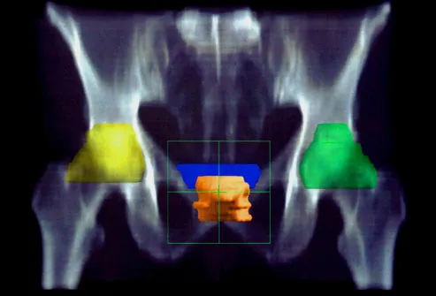 CT Scan Showing Prostate