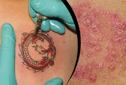 Tattoos can look cool, but to psoriatic skin the tattooing process can be a 