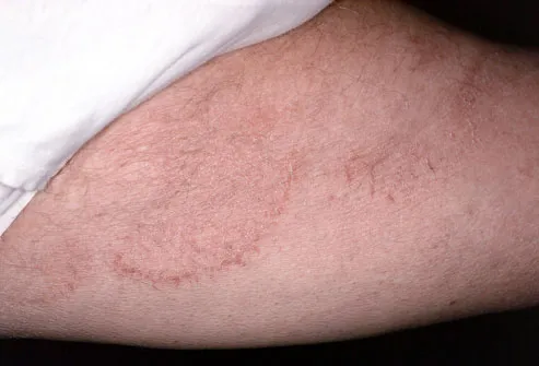 Tinea cruris, also known as jock itch