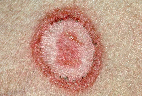 Close-up of tinea corporis, also known as ringworm