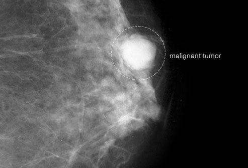 Mammogram Showing Malignant Tumor