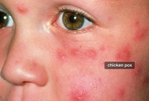 What do the symptoms of shingles appear as on the body?
