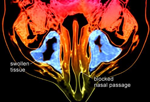MRI showing stuffed up sinuses