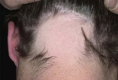 What causes hair to grow on a woman's chin and neck?