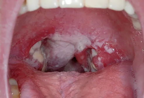 Babys Swollen Throat Virus 37