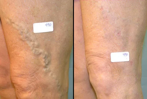 Before and after varicose vein surgery