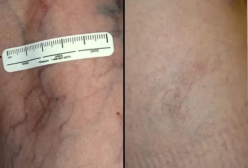 spider veins before and after laser therapy