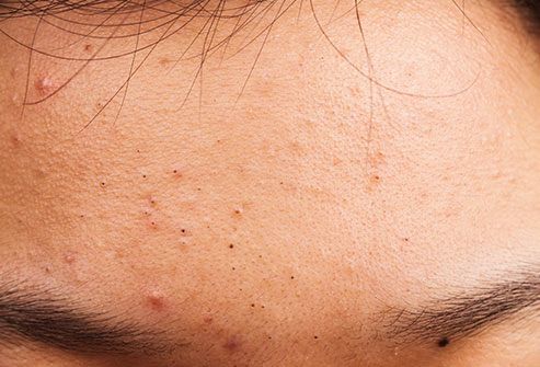 Steroid creams for face rash