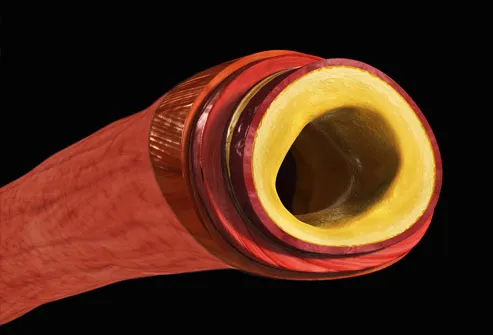 Sectioned Artery with Blockage