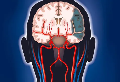 Illustration of Brain Damage from Stroke