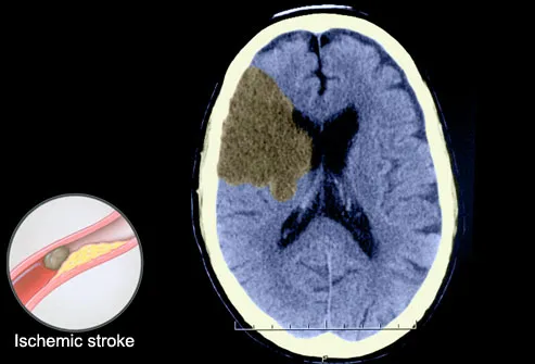 Ischemic Stroke Seen on CT Scan of Brain