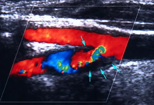 TIA Mini Stroke Highlighted on Ultrasound