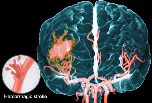 Hemorrhagic Stroke Seen on MRA of Brain
