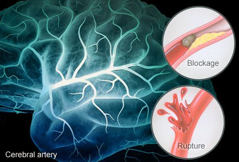 Anti-epilepsy drug preserves brain function after stroke 