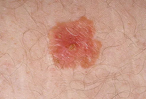Bacteria could contribute to development of wound-induced skin cancer
