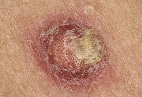 Squamous cell carcinoma is