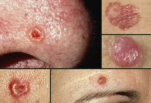 Various presentations of basal cell carcinoma