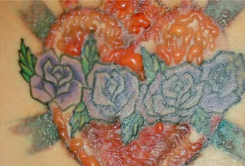 Not every tattoo comes off perfectly. This picture shows scarring caused by 