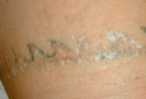 This picture shows scarring caused by attempted laser tattoo removal.