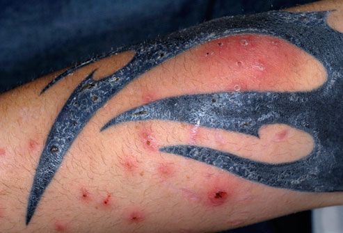 Tattoo Risks: Infection