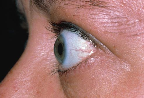 Bulging Eyes From Graves Disease