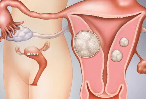 causes of uterine bleeding between periods