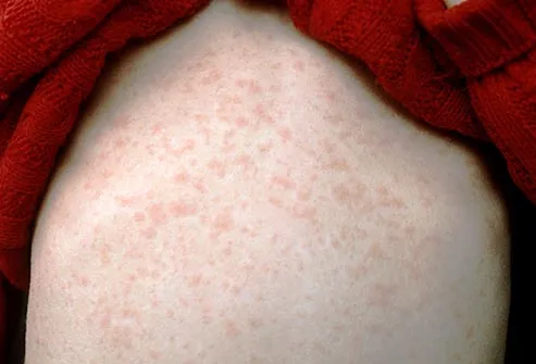 Rash | Dermatitis | Skin Rash | MedlinePlus