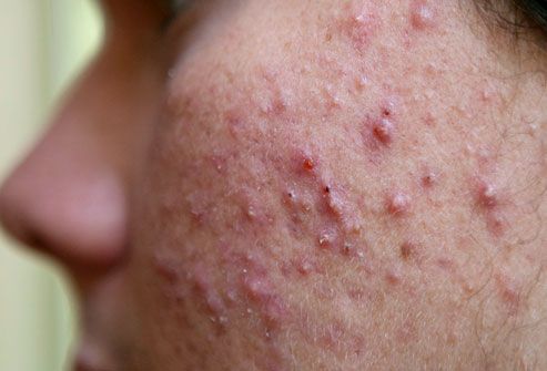Teen boy with cystic acne
