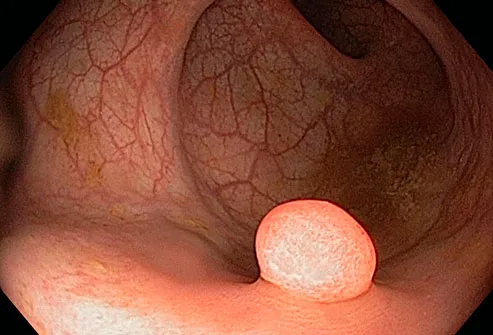 polyp in colon