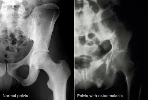 左：通常の骨盤　右：骨軟化症の骨盤