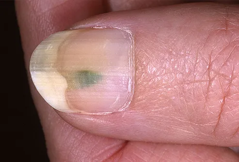 Изменение цвета ногтей может быть вызвано разными причинами. Среди