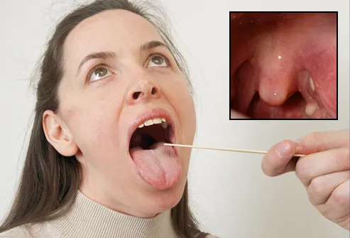 Tonsil Rupture
