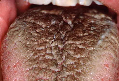Black hairy tongue symptoms, treatments, causes, and more