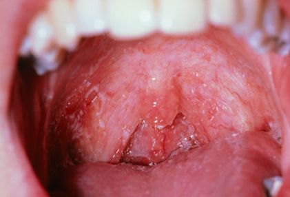 sores on tongue. canker sores, and hairy